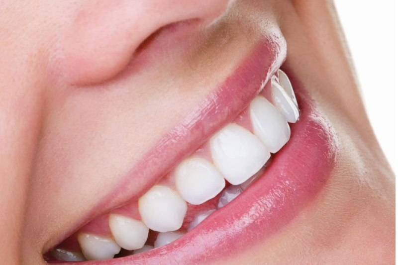 TOOTH WHITENING