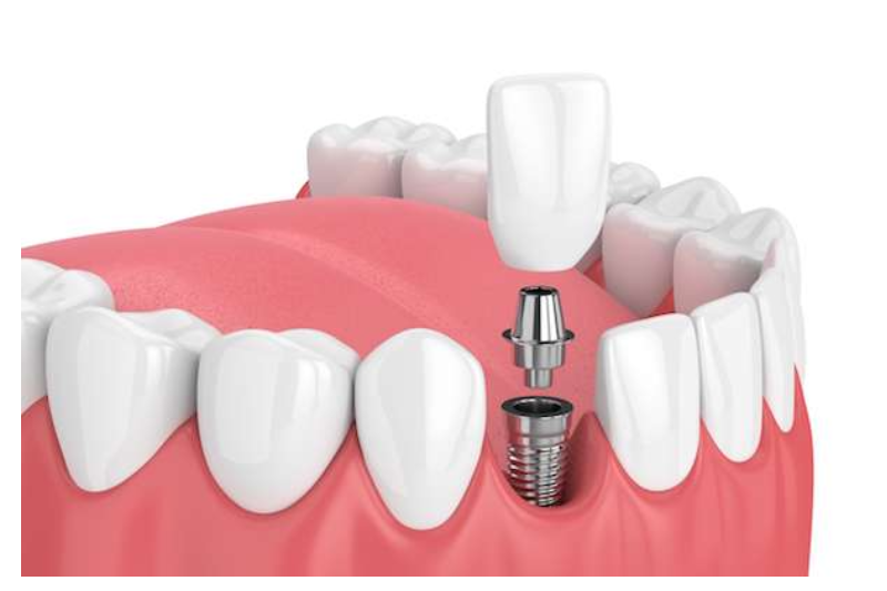 DENTAL IMPLANTS