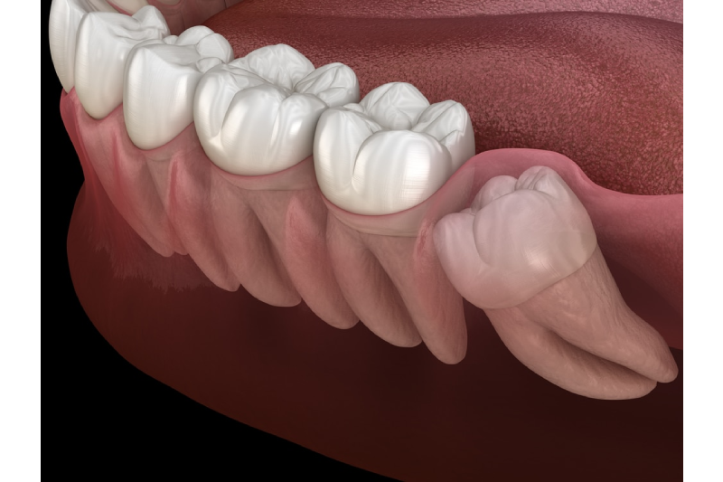IMPACTION (WISDOM TEETH)