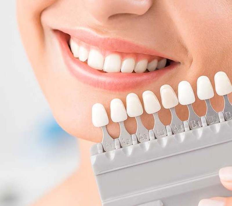 VENEERS AND LAMINATES